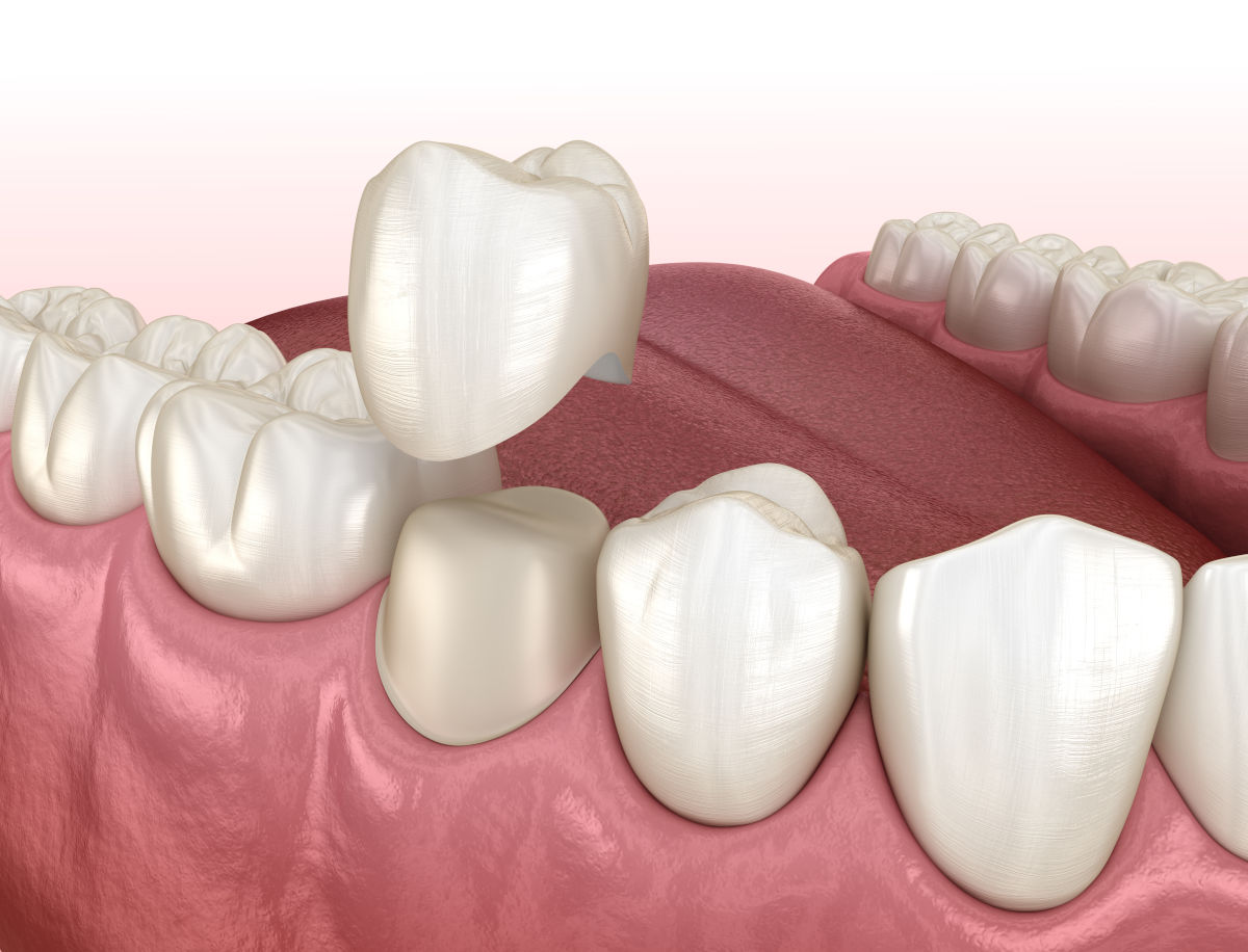Dental Crowns in Thailand: Types & Cost