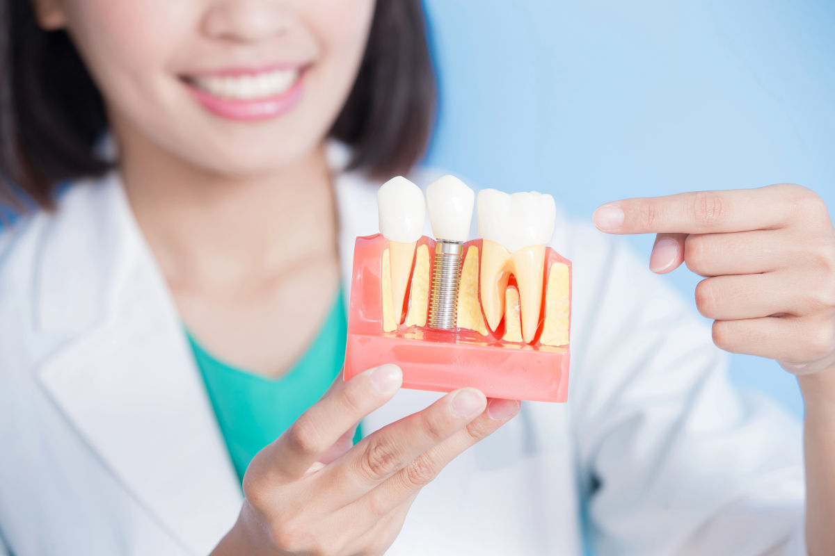 Dental Implants in Thailand: Cost & Procedure